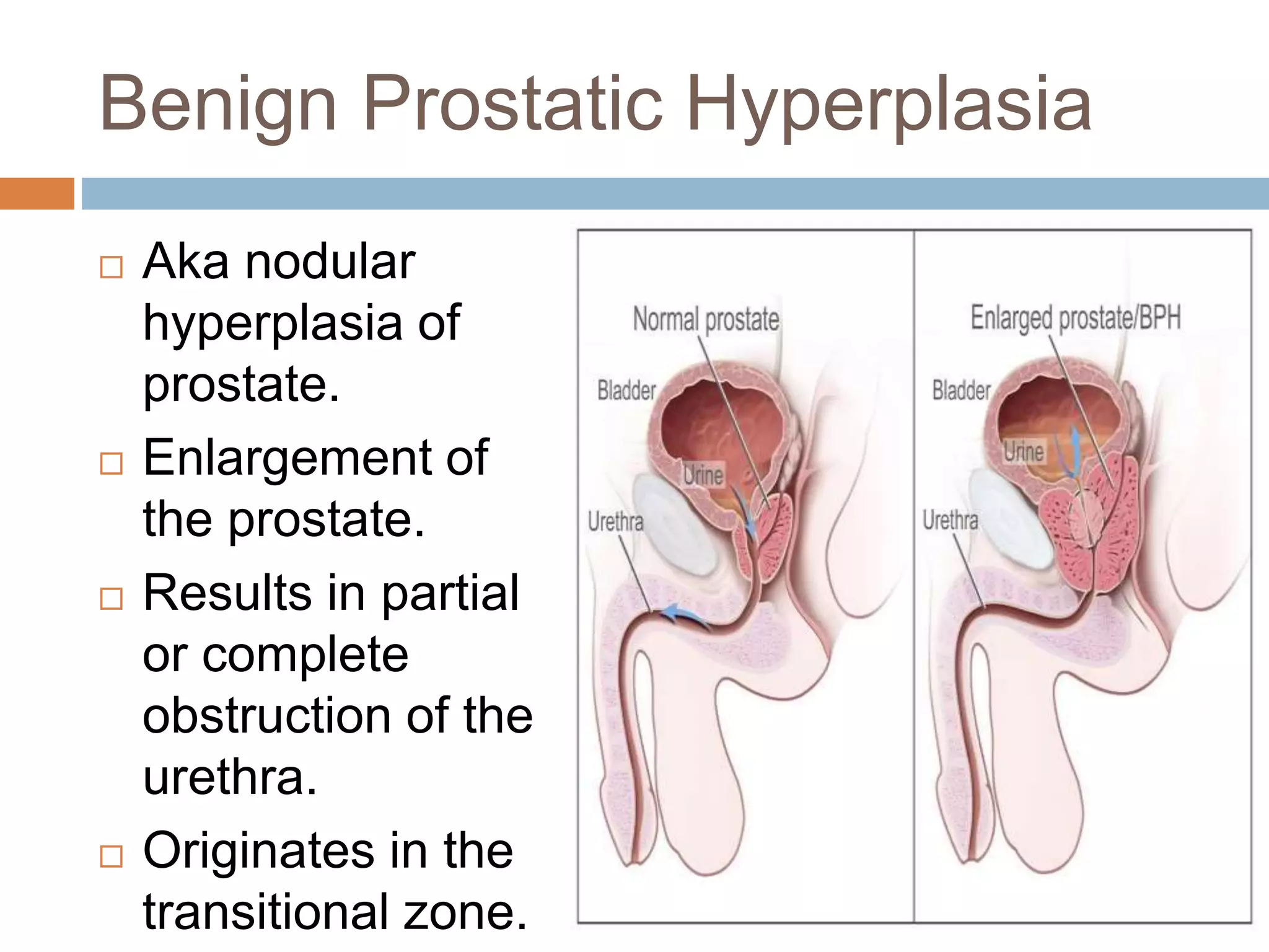 Benign Prostatic Hyperplasia
 Aka nodular
hyperplasia of
prostate.
 Enlargement of
the prostate.
 Results in partial
or complete
obstruction of the
urethra.
 Originates in the
transitional zone.
 