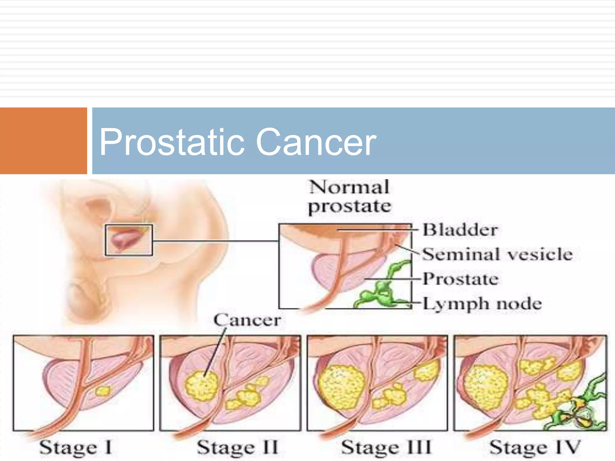 Prostatic Cancer
 