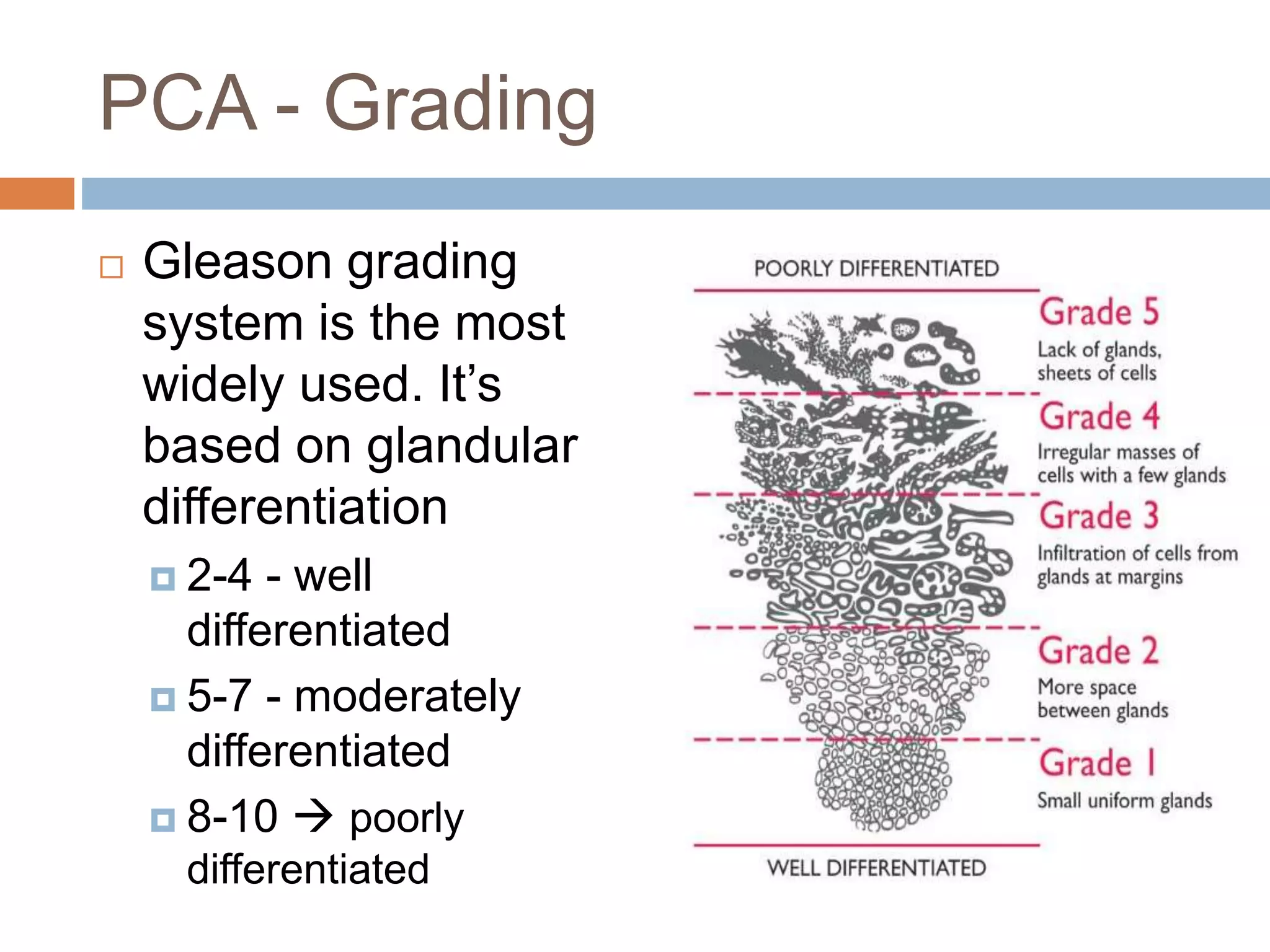 PCA - Grading
 Gleason grading
system is the most
widely used. It’s
based on glandular
differentiation
 2-4 - well
differentiated
 5-7 - moderately
differentiated
 8-10  poorly
differentiated
 