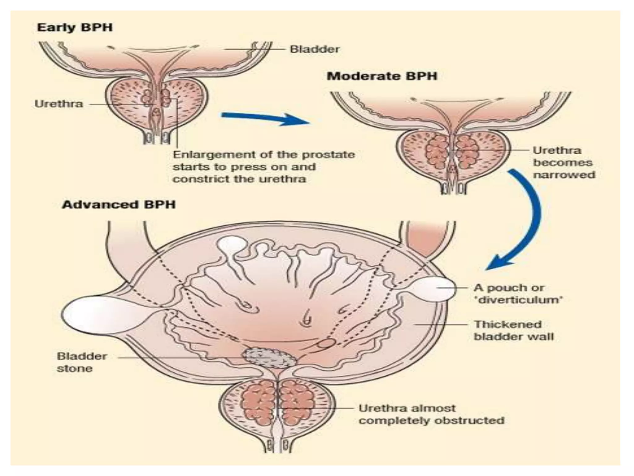 PROSTATE CANCER ANATOMY AND PHYSIOLOGY visual data 4