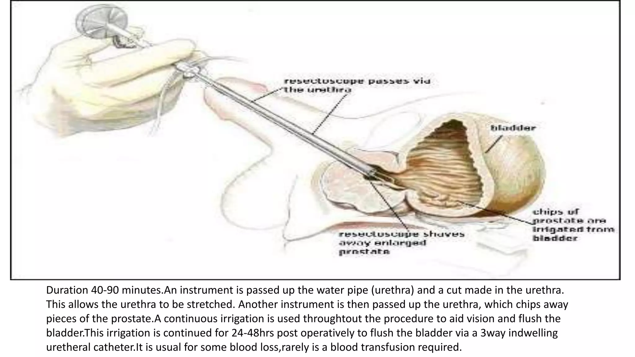 Prostate | PPTX