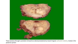 These sections through a prostate removed via radical prostatectomy reveal irregular yellowish nodules, mostly in the
posterior portion
 