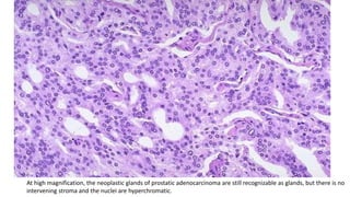 At high magnification, the neoplastic glands of prostatic adenocarcinoma are still recognizable as glands, but there is no
intervening stroma and the nuclei are hyperchromatic.
 