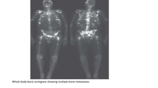 Whole body bone scintigram showing multiple bone metastases.
 