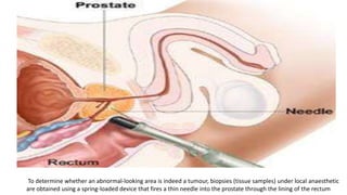 To determine whether an abnormal-looking area is indeed a tumour, biopsies (tissue samples) under local anaesthetic
are obtained using a spring-loaded device that fires a thin needle into the prostate through the lining of the rectum
 