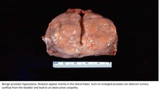 Benign prostatic hyperplasia. Nodules appear mainly in the lateral lobes. Such an enlarged prostate can obstruct urinary
outflow from the bladder and lead to an obstructive uropathy.
 