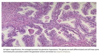 At higher magnification, the enlarged prostate has glandular hyperplasia. The glands are well-differentiated and still have some
laminated pink concretions within the glandular lumens are known as corpora amylacea.
 