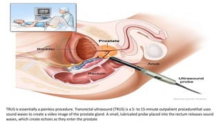TRUS is essentially a painless procedure. Transrectal ultrasound (TRUS) is a 5- to 15-minute outpatient procedurethat uses
sound waves to create a video image of the prostate gland. A small, lubricated probe placed into the rectum releases sound
waves, which create echoes as they enter the prostate
 