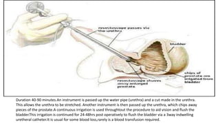 Duration 40-90 minutes.An instrument is passed up the water pipe (urethra) and a cut made in the urethra.
This allows the urethra to be stretched. Another instrument is then passed up the urethra, which chips away
pieces of the prostate.A continuous irrigation is used throughtout the procedure to aid vision and flush the
bladder.This irrigation is continued for 24-48hrs post operatively to flush the bladder via a 3way indwelling
uretheral catheter.It is usual for some blood loss,rarely is a blood transfusion required.
 
