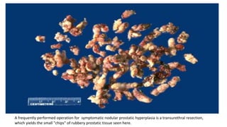 A frequently performed operation for symptomatic nodular prostatic hyperplasia is a transurethral resection,
which yields the small "chips" of rubbery prostatic tissue seen here.
 