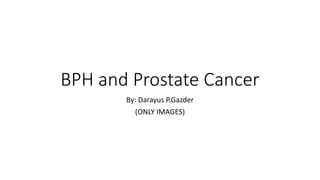 BPH and Prostate Cancer
By: Darayus P.Gazder
(ONLY IMAGES)
 