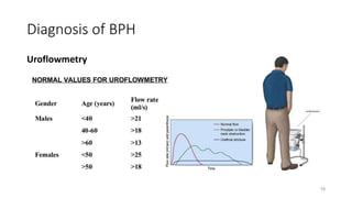 Diagnosis of BPH
Uroflowmetry
19
 