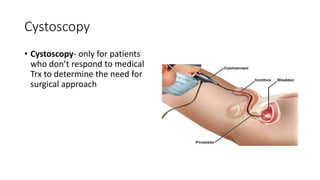 Cystoscopy
• Cystoscopy- only for patients
who don’t respond to medical
Trx to determine the need for
surgical approach
 