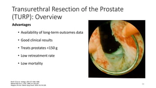 Transurethral Resection of the Prostate
(TURP): Overview
Advantages
• Availability of long-term outcomes data
• Good clinical results
• Treats prostates <150 g
• Low retreatment rate
• Low mortality
30
Borth CS et al. Urology. 2001;57:1082-1086.
Mebust WK et al. J Urol. 1989;141:243-247.
Wagner JR et al. Semin Surg Oncol. 2000;18:216-228.
 
