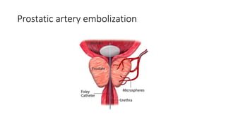 Prostatic artery embolization
 