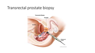 Transrectal prostate biopsy
 