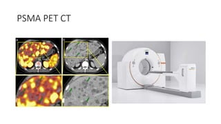 PSMA PET CT
 