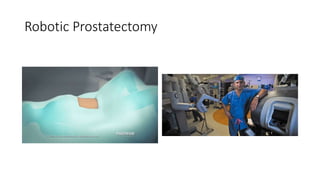 Robotic Prostatectomy
 