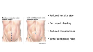 • Reduced hospital stay
• Decreased bleeding
• Reduced complications
• Better continence rates
 