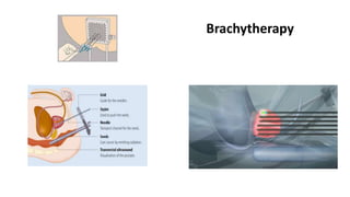 Brachytherapy
 