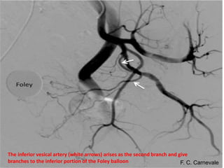 The inferior vesical artery (white arrows) arises as the second branch and give
branches to the inferior portion of the Foley balloon F. C. Carnevale