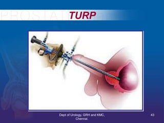TURP
43
Dept of Urology, GRH and KMC,
Chennai.
 