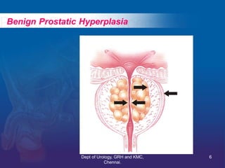 Prostate BPH- evaluation & management | PDF