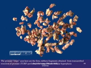 The prostate "chips" seen here are the firm, rubbery fragments obtained from transurethral
resection of prostate (TURP) pe...