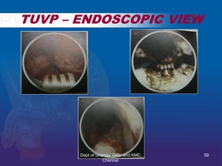 TUVP – ENDOSCOPIC VIEW
59
Dept of Urology, GRH and KMC,
Chennai.
 