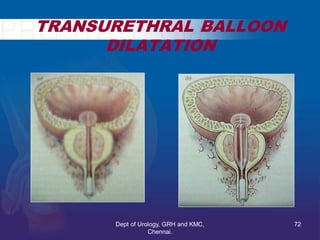 TRANSURETHRAL BALLOON
DILATATION
72
Dept of Urology, GRH and KMC,
Chennai.
 