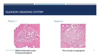 Prostate carcinoma- etiopathogenesis | PDF
