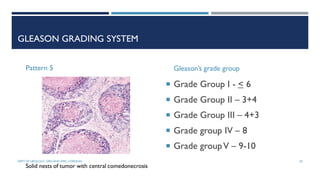 Gleason Pattern Solid Prostate carcinoma- etiopathogenesis | PDF