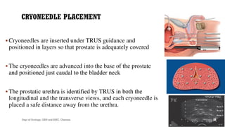  Cryoneedles are inserted under TRUS guidance and
positioned in layers so that prostate is adequately covered
 The cryoneedles are advanced into the base of the prostate
and positioned just caudal to the bladder neck
 The prostatic urethra is identified by TRUS in both the
longitudinal and the transverse views, and each cryoneedle is
placed a safe distance away from the urethra.
28
Dept of Urology, GRH and KMC, Chennai.
 
