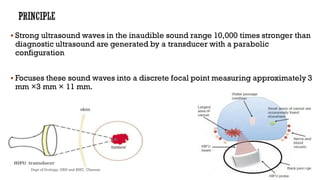  Strong ultrasound waves in the inaudible sound range 10,000 times stronger than
diagnostic ultrasound are generated by a transducer with a parabolic
configuration
 Focuses these sound waves into a discrete focal point measuring approximately 3
mm ×3 mm × 11 mm.
45
Dept of Urology, GRH and KMC, Chennai.
 