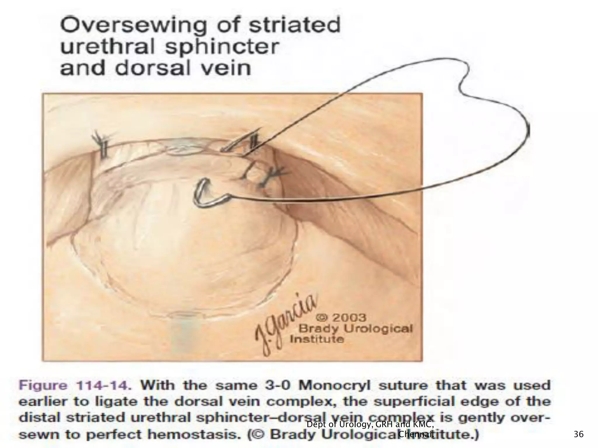 Retropubic Incision Prostate carinoma- surgery- Open Radical Retropubic Prostatectomy(rrp ...
