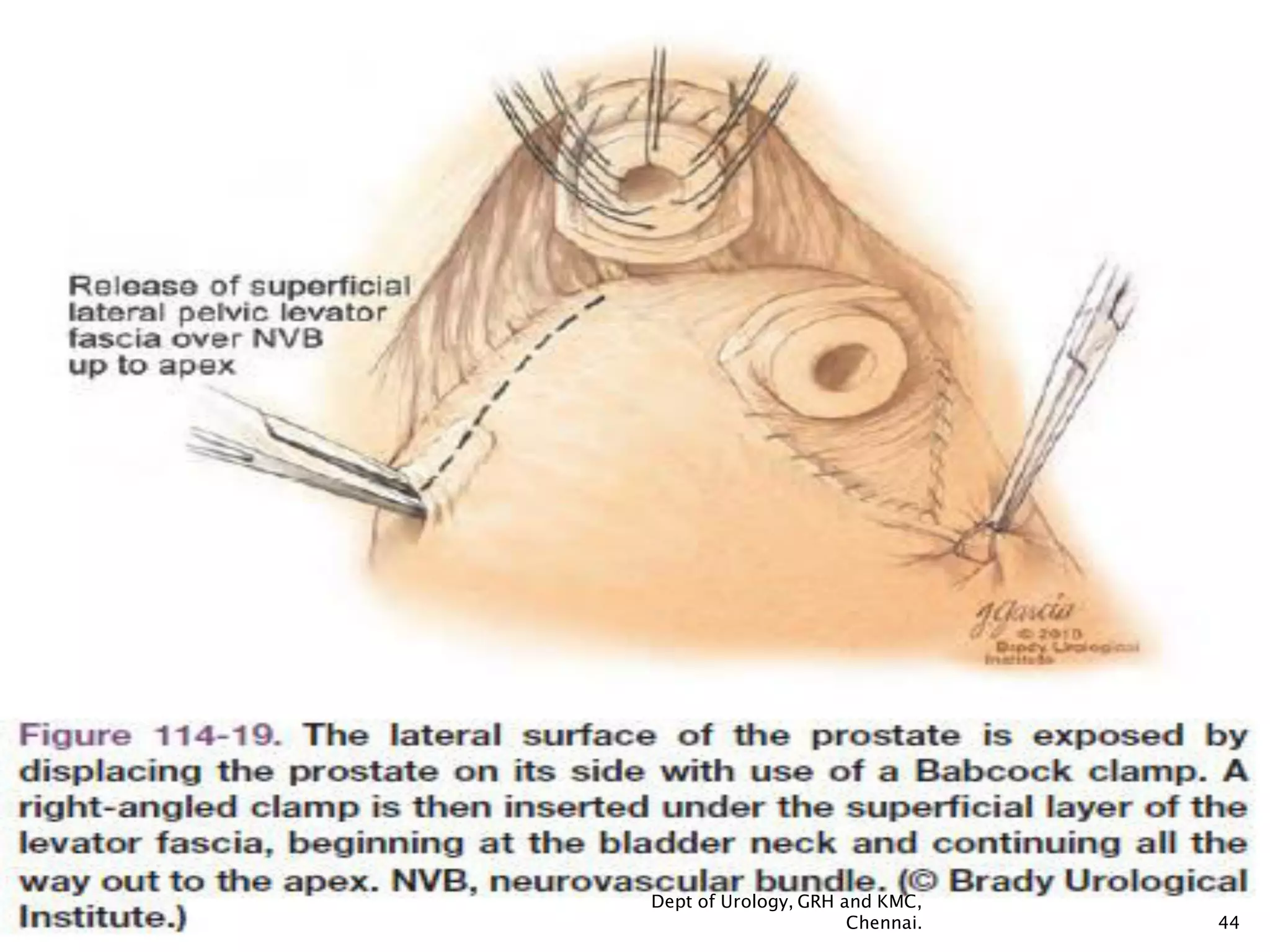 Retropubic Incision Retropubic Prostatectomy Definition Math – XNTT