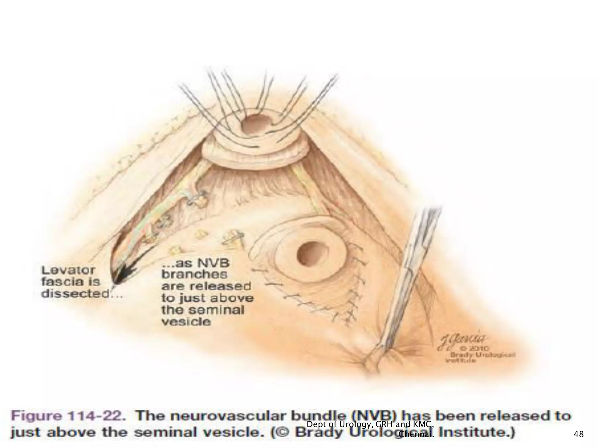 Retropubic Incision Prostate carinoma- surgery- Open Radical Retropubic Prostatectomy(rrp ...