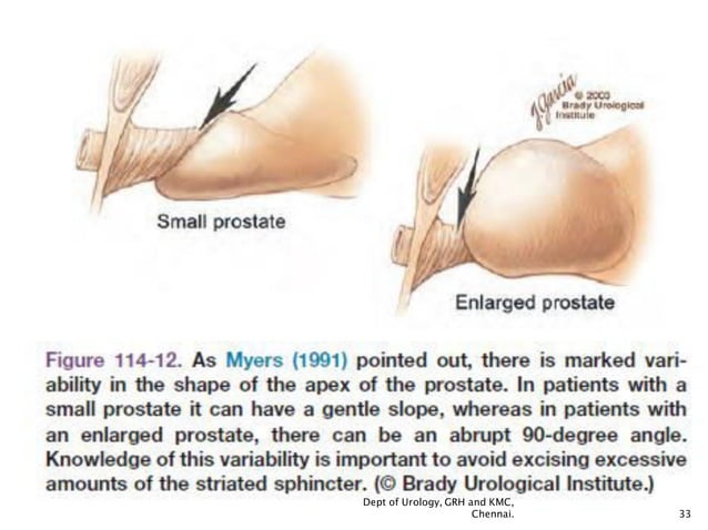 Retropubic Incision Prostate carinoma- surgery- Open Radical Retropubic Prostatectomy(rrp ...