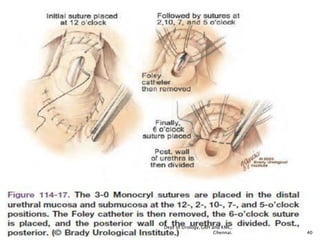 Retropubic Incision Prostate carinoma- surgery- Open Radical Retropubic Prostatectomy(rrp ...