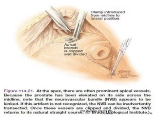 Retropubic Incision Prostate carinoma- surgery- Open Radical Retropubic Prostatectomy(rrp ...