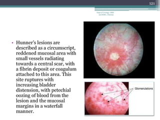 • Hunner’s lesions are
described as a circumscript,
reddened mucosal area with
small vessels radiating
towards a central scar, with
a fibrin deposit or coagulum
attached to this area. This
site ruptures with
increasing bladder
distension, with petechial
oozing of blood from the
lesion and the mucosal
margins in a waterfall
manner.
121
Dept of Urology, GRH
and KMC, Chennai.
 