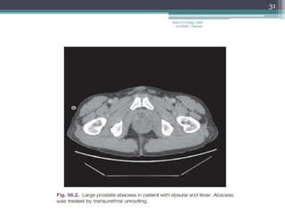 31
Dept of Urology, GRH
and KMC, Chennai.
 