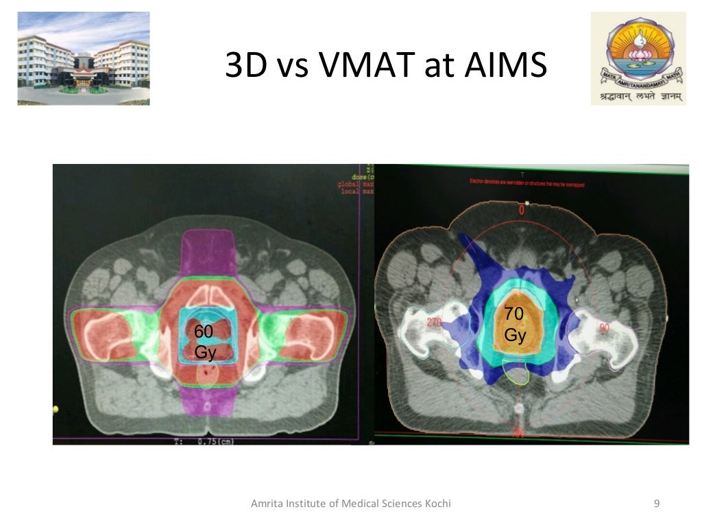 IMRT in Prostate Cancer