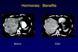 Hormones: Benefits
70
Before After
 