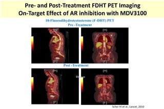 Pre- and Post-Treatment FDHT PET Imaging
On-Target Effect of AR inhibition with MDV3100
18-Fluorodihydrotestosterone (F-DHT) PET
Pre -Treatment
Post -Treatment
Scher HI et al., Lancet, 2010
Dosage
 
