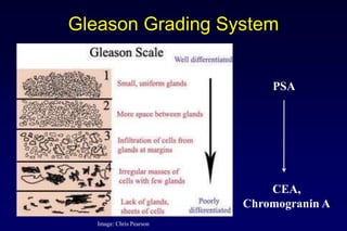 Gleason Grading System
CEA,
Chromogranin A
PSA
Image: Chris Pearson
 