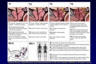 Iyer Cancer 1999
Simone Kaiser: Identification and Characterization of the Ion Channel TRPM8 in Prostate Cancer
 