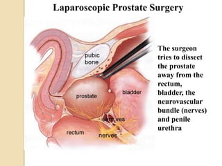 Laparoscopic Prostate Surgery
The surgeon
tries to dissect
the prostate
away from the
rectum,
bladder, the
neurovascular
bundle (nerves)
and penile
urethra
 