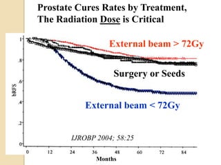 External beam > 72Gy
External beam < 72Gy
Surgery or Seeds
Prostate Cures Rates by Treatment,
The Radiation Dose is Critical
Months
IJROBP 2004; 58:25
 