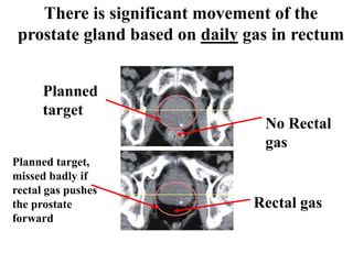 There is significant movement of the
prostate gland based on daily gas in rectum
Planned
target
Rectal gas
No Rectal
gas
Planned target,
missed badly if
rectal gas pushes
the prostate
forward
 